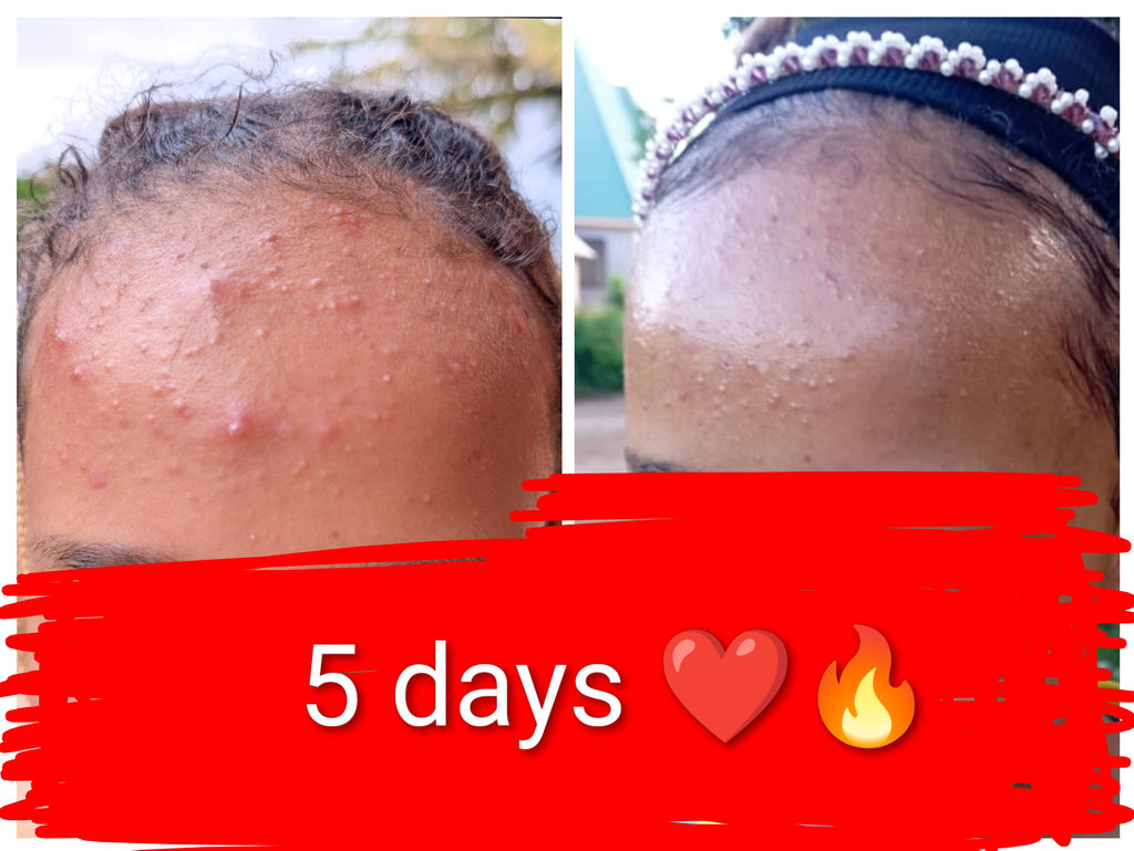 Radiance Toner 🔥 (acne treatment)